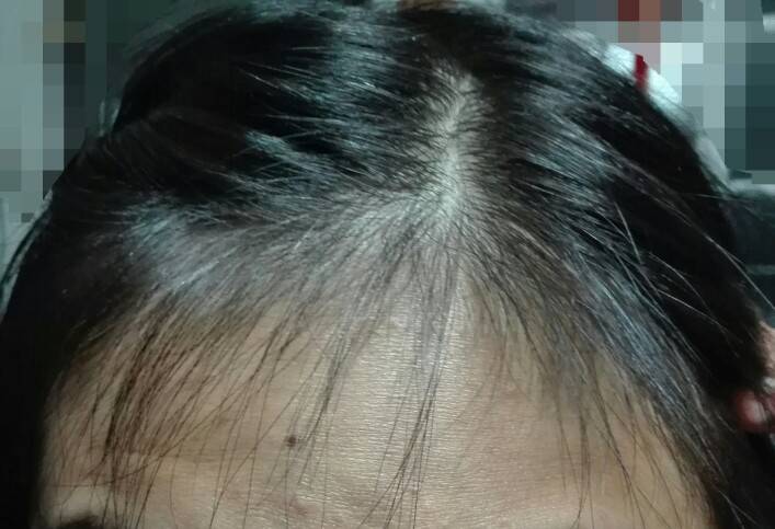 掉的没见长～好奇怪～匿名2015-11-02 19:26:18来自:系统性红斑狼疮