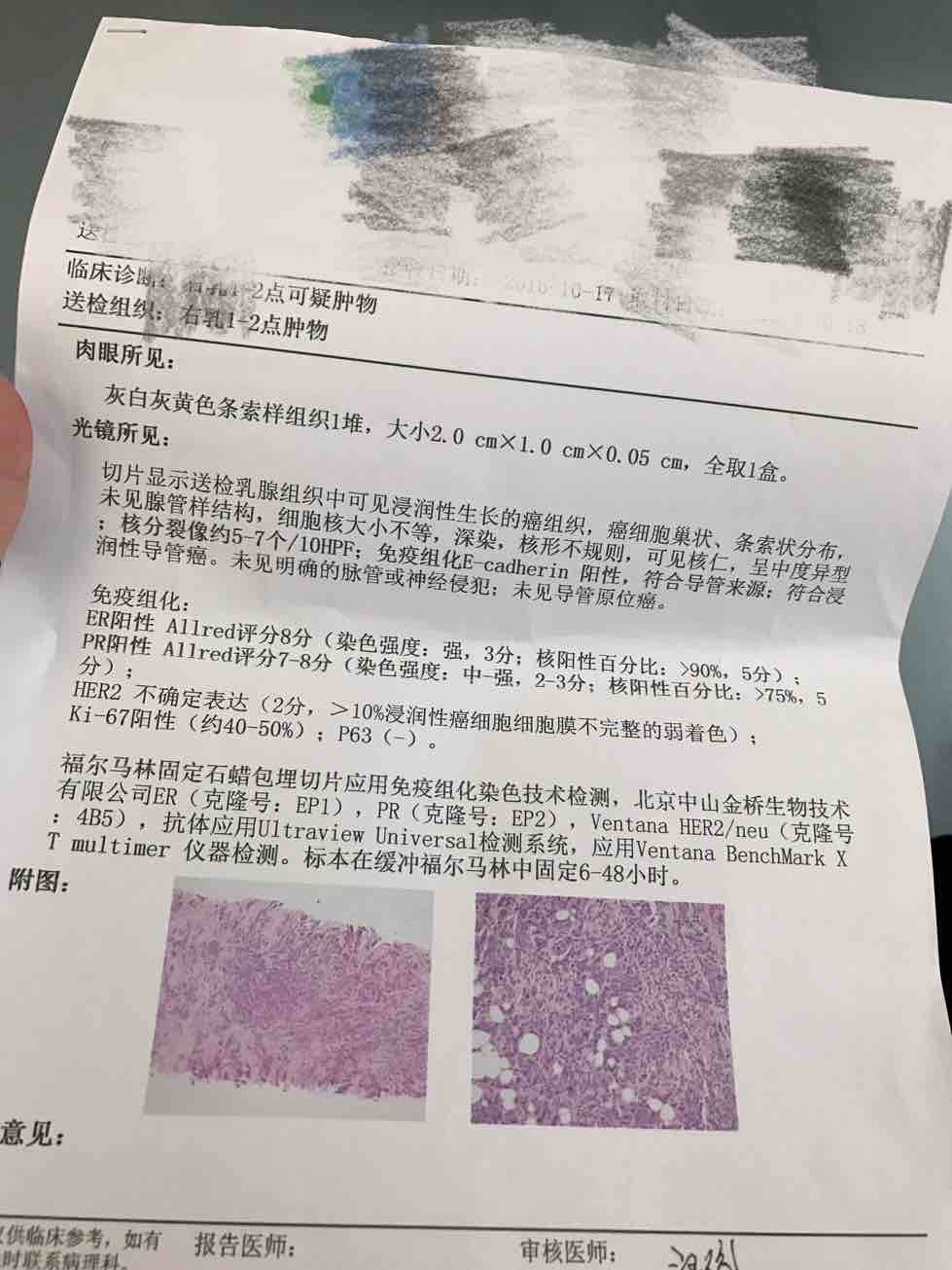 确诊浸润性导管癌2级 有人懂看病理么 严重程度到哪了