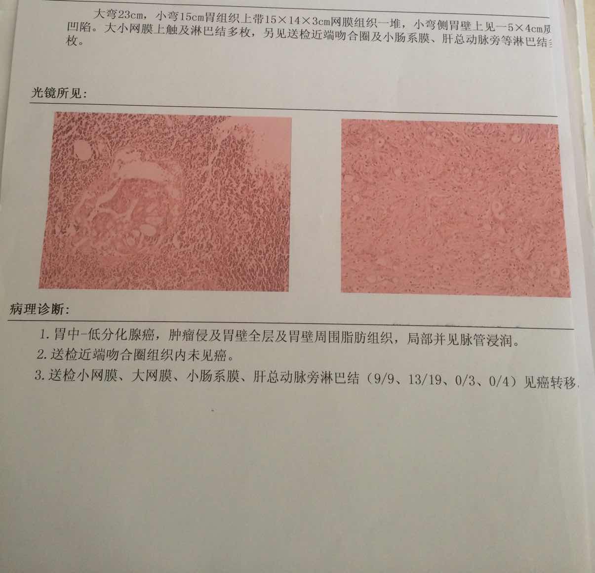 胃窦中低化腺癌,该不该化疗?麻烦大家帮帮我