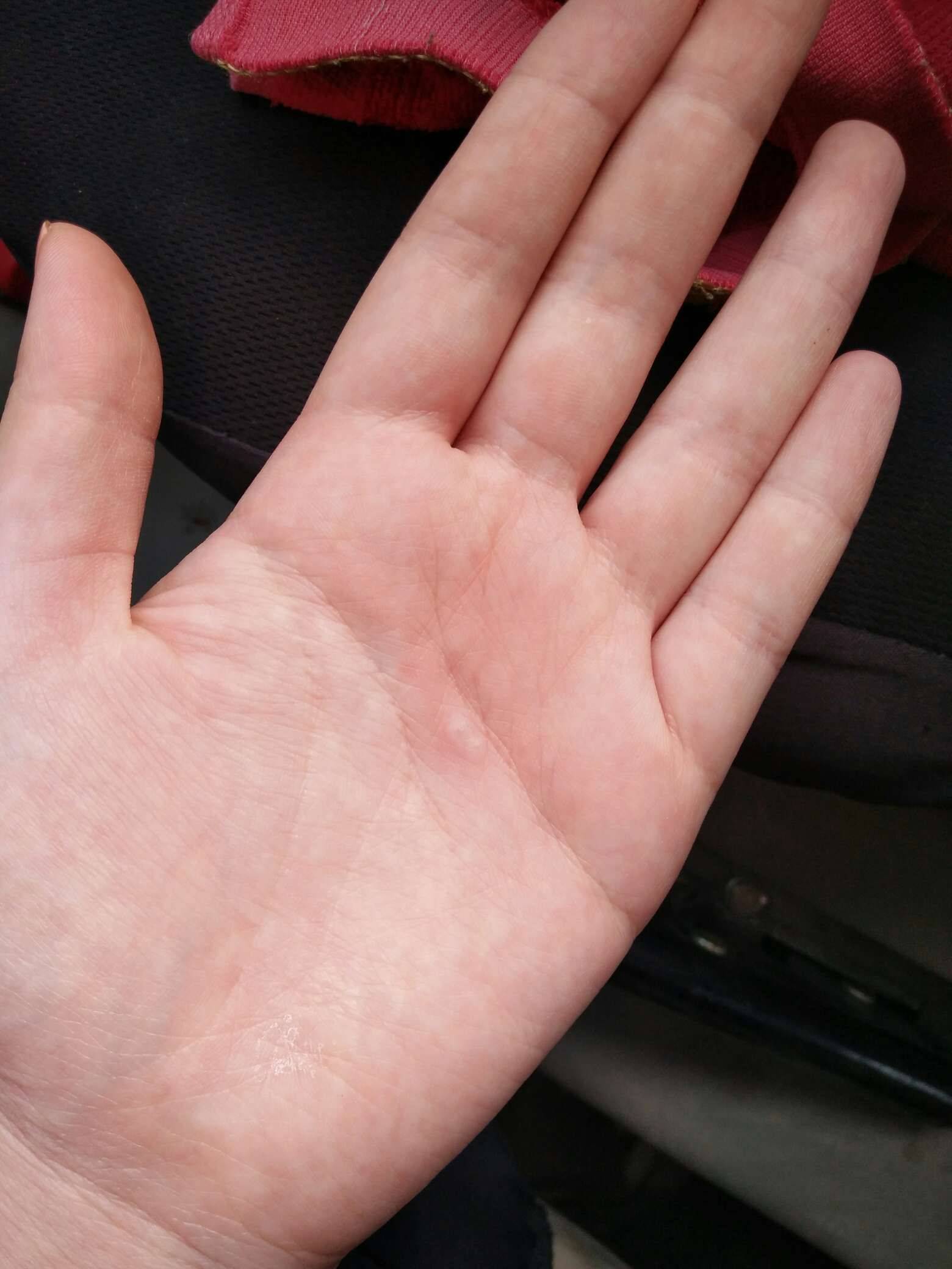 请医生看下我手背的干裂和红点，这是被冻的还是一种皮疹_皮肤科_邻医网