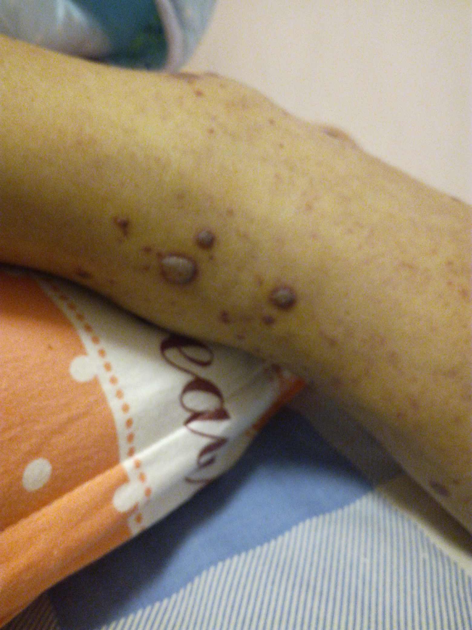 指标都不高当时看片子都怀疑肺癌 伴有转移 结果出来后又觉得是结核