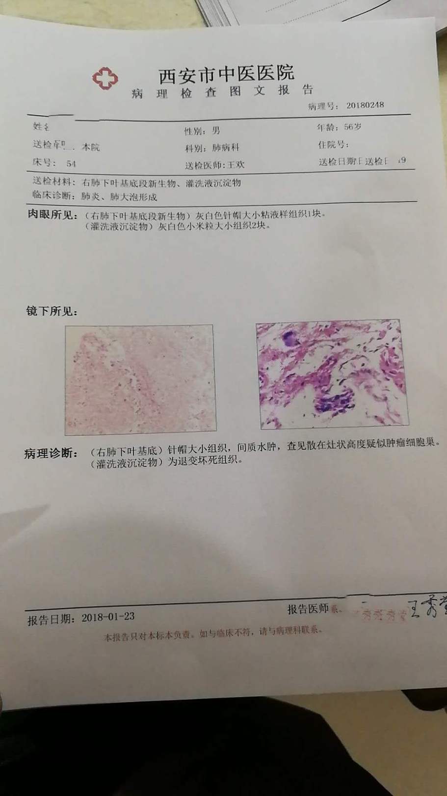 我爸于前天日因感冒咳嗽一直没好检查出肺癌麻烦帮我确认谢