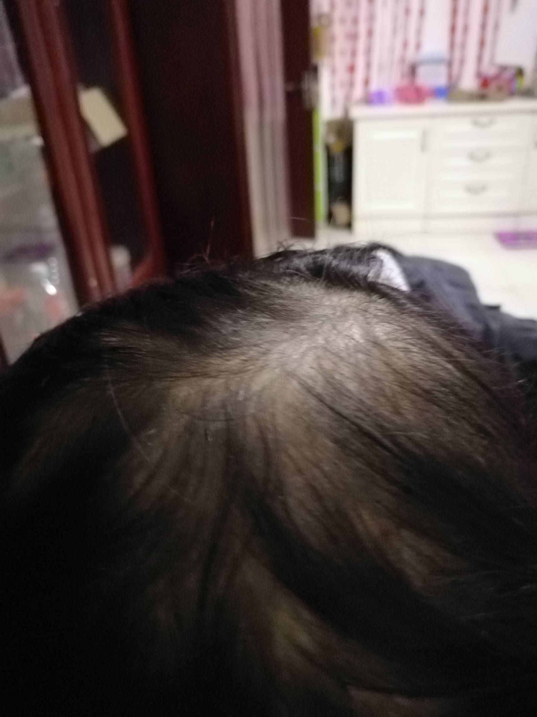 秃顶了又