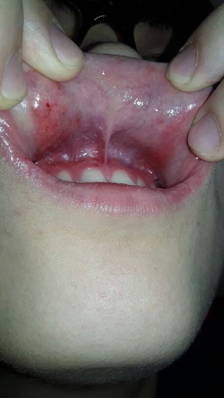 门牙后面牙龈肿痛而且口腔里长了很多小红点-系统性红斑狼疮患者互助
