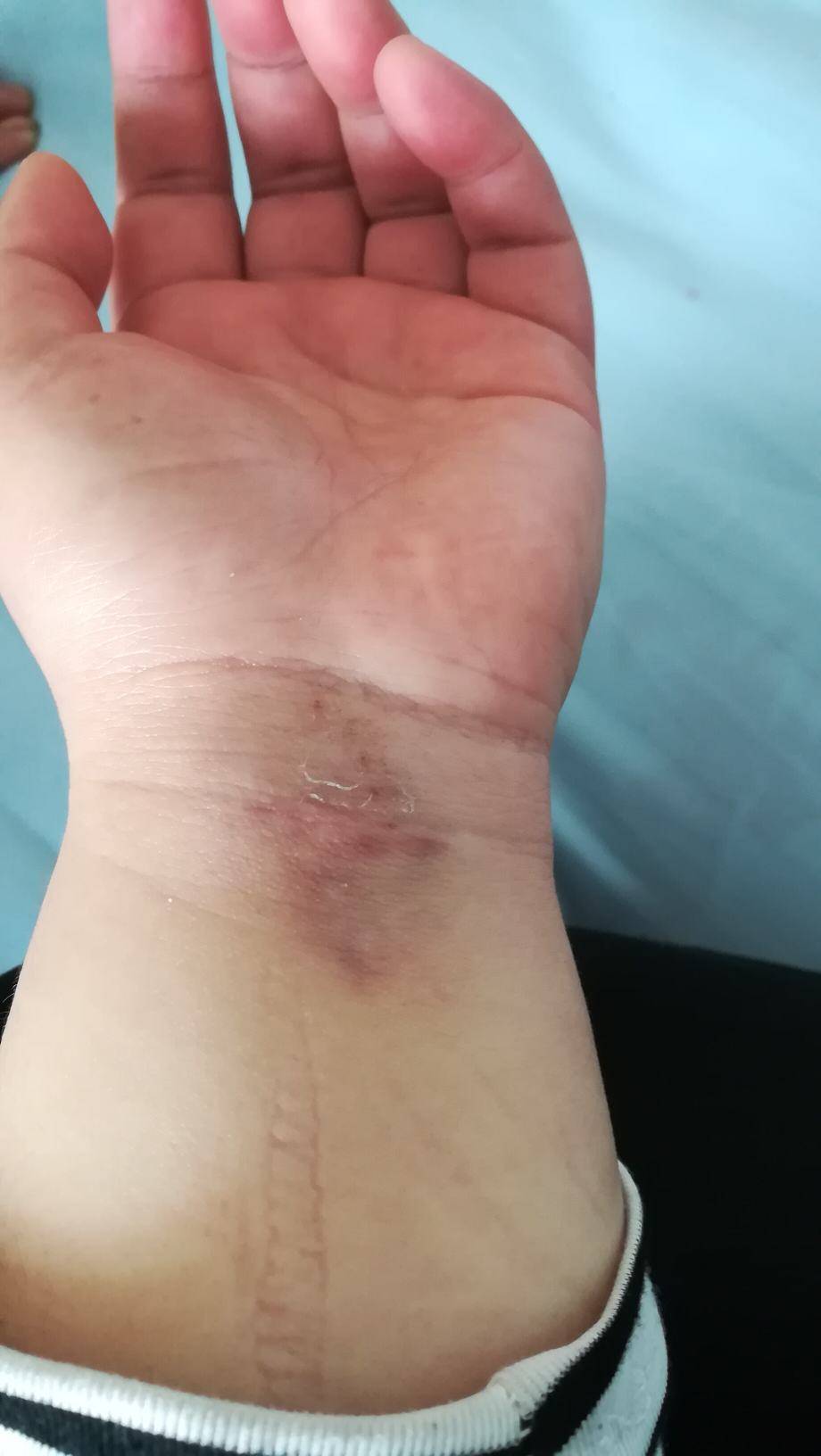 坐等扎针,希望一针见血,让我少遭罪,到处都是针印子,我的胖手惨不忍睹