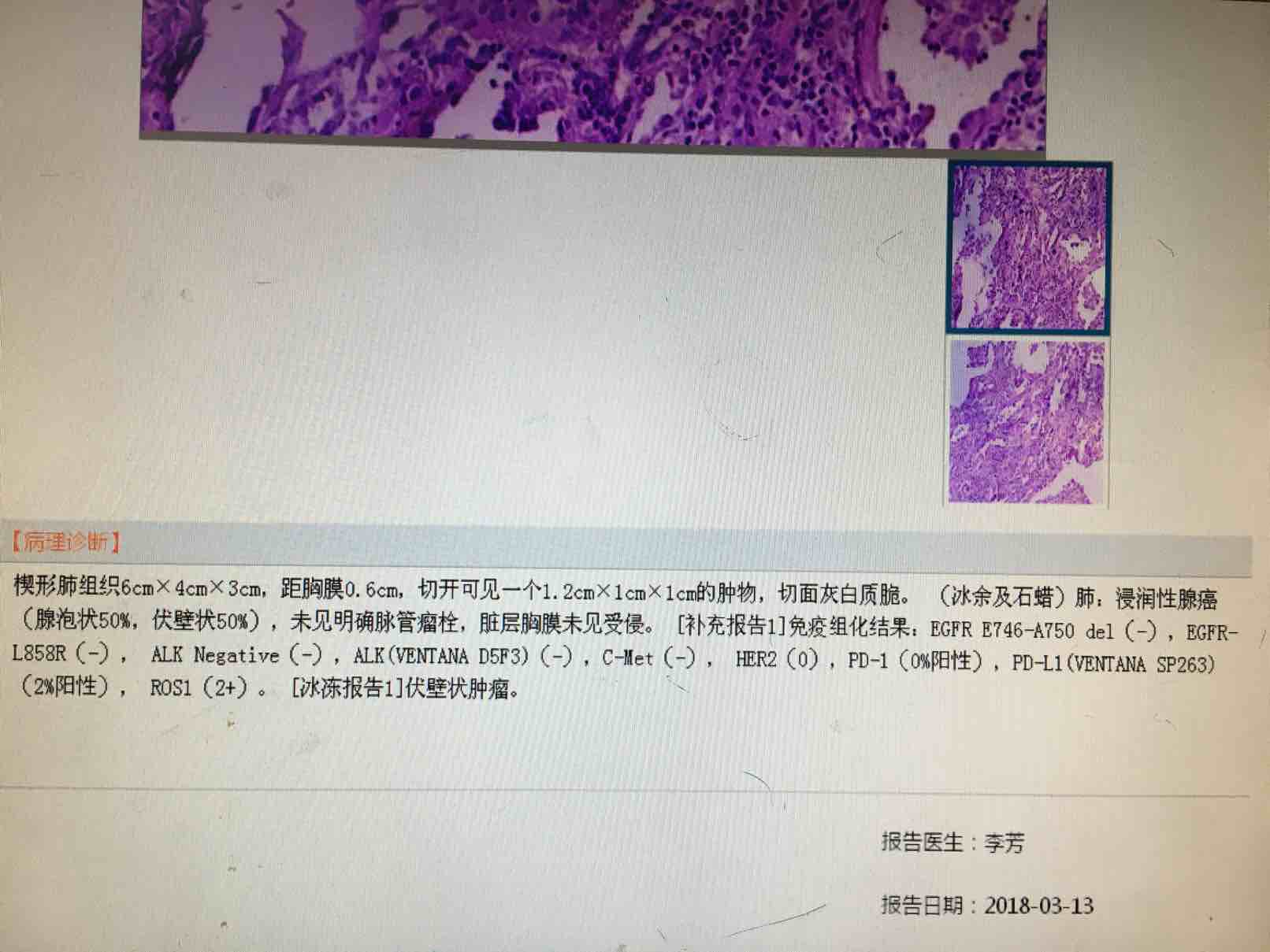 浸润性腺癌肿瘤大小12701701腺泡50贴壁50预后如何