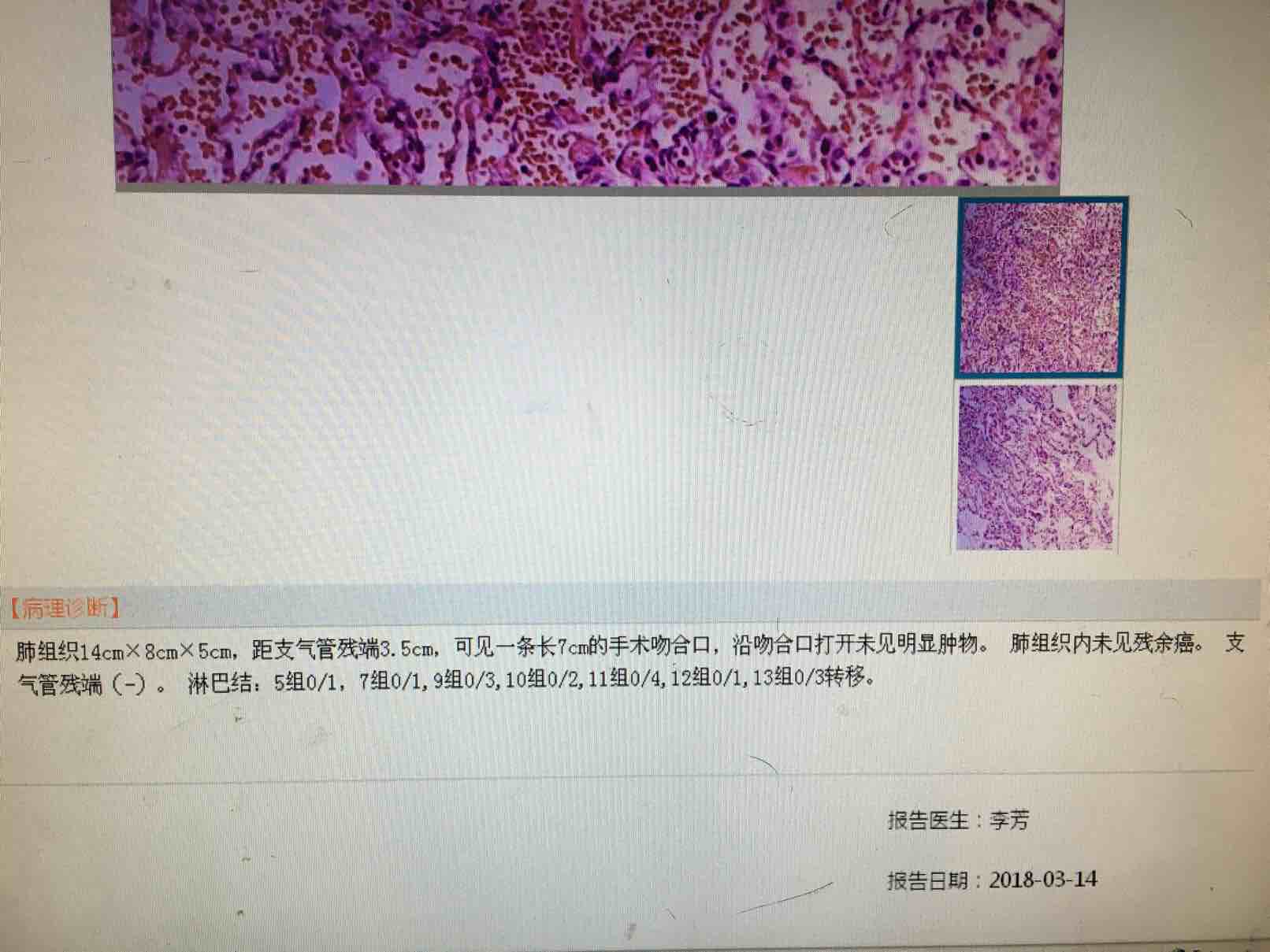 浸润性腺癌肿瘤大小12701701腺泡50贴壁50预后如何