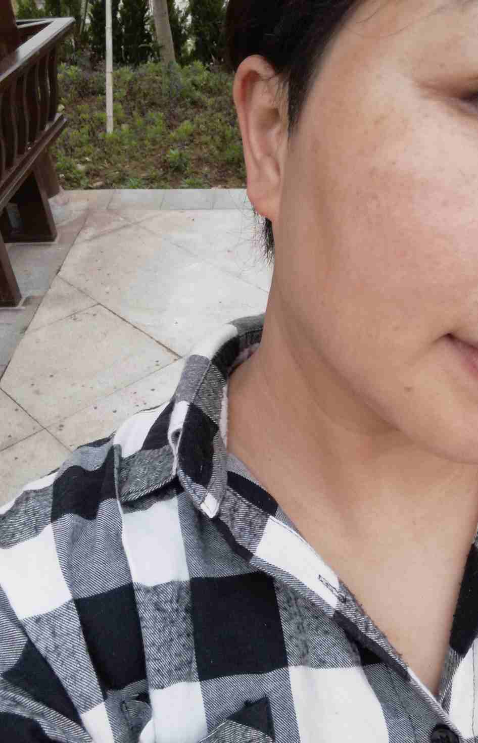 整张脸黑红黑红的,这是什么?黄褐斑吗?还是化疗后或靶向治疗的副作用?