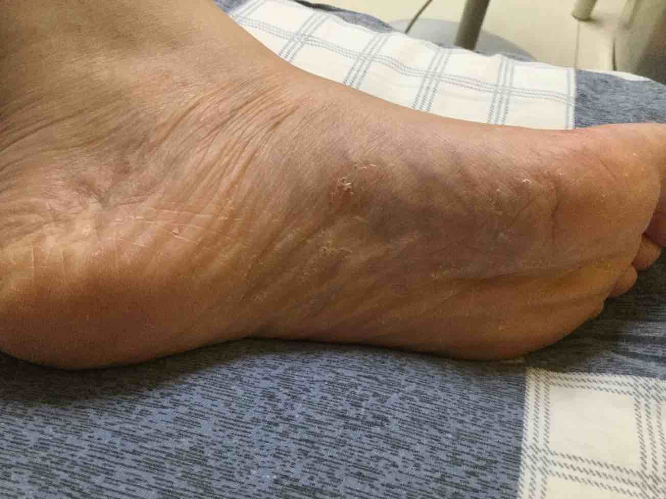 脚痒是脚气吗_王毅医生的语音科普_妙手医生