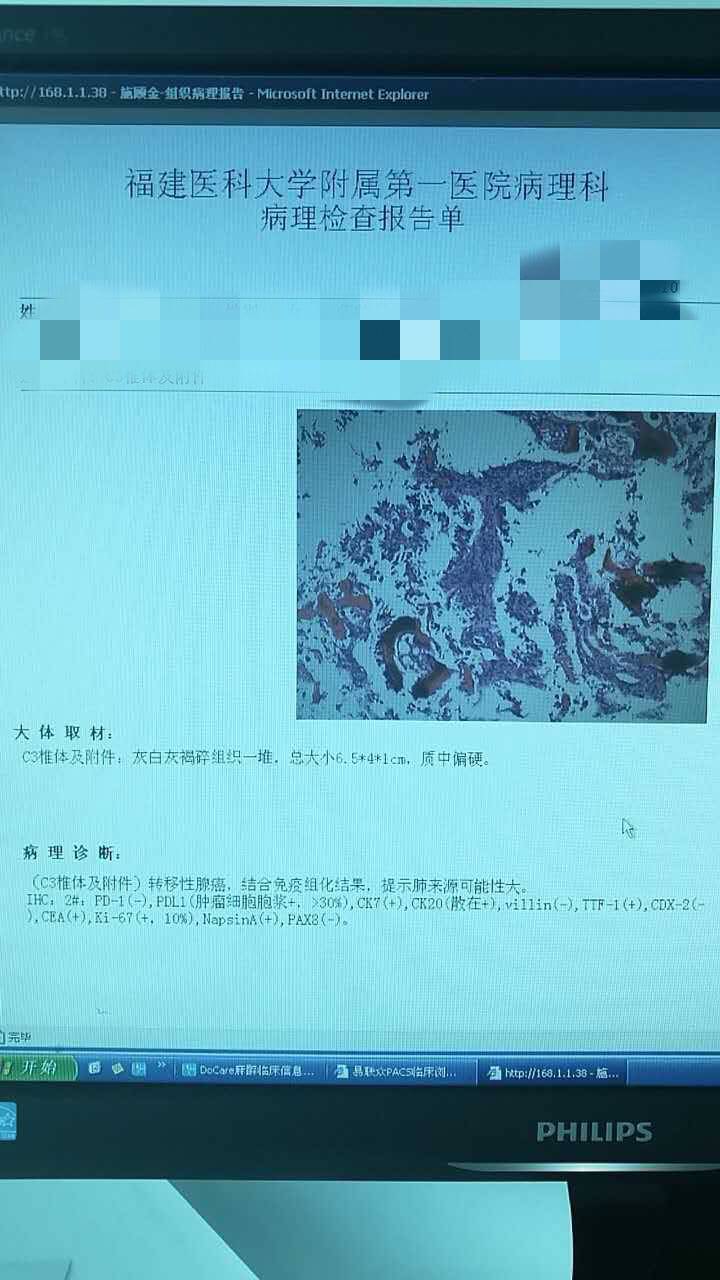 请帮忙看看妈妈的免疫组化报告单