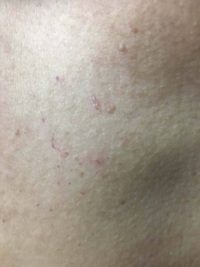 化疗结束半个月后最近身上过敏怎么回事-肺癌康复圈