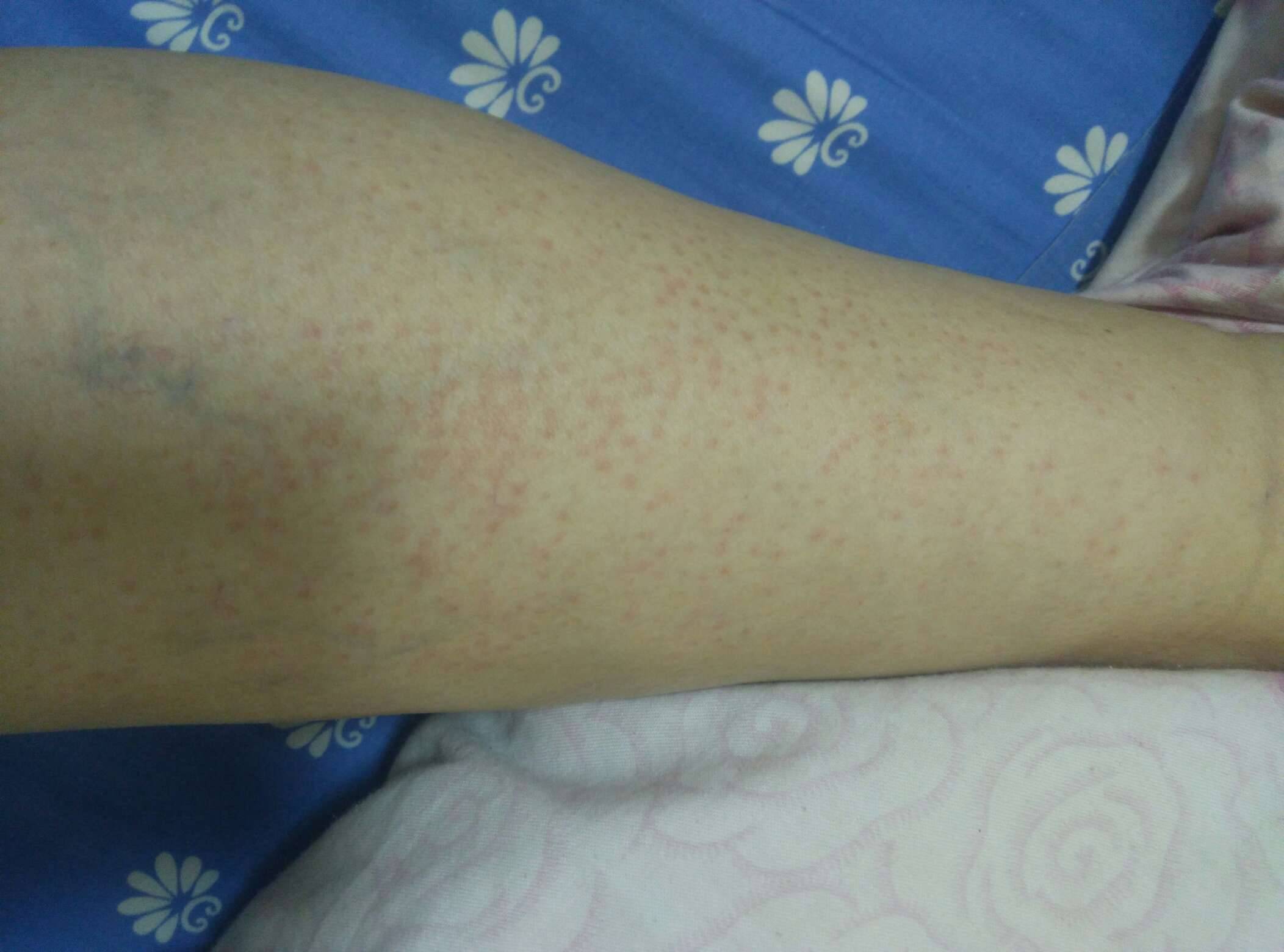 这刚洗完澡腿就这样了,用澡巾搓的,每次都这样搓,这次怎么会这样?