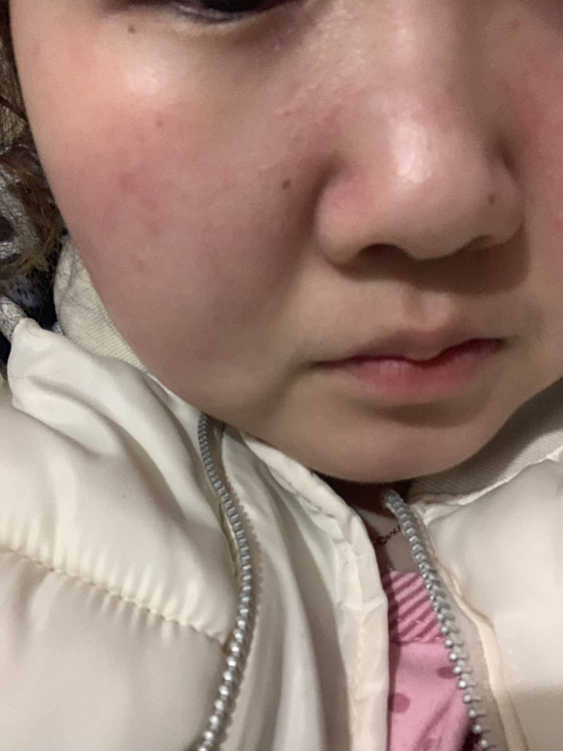 红疹-系统性红斑狼疮康复圈--觅健