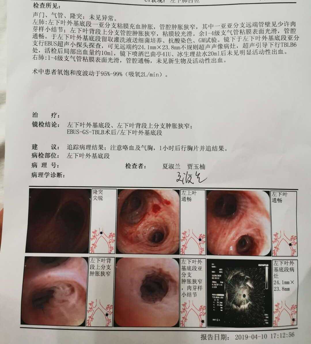 支气管镜个petct检查结果