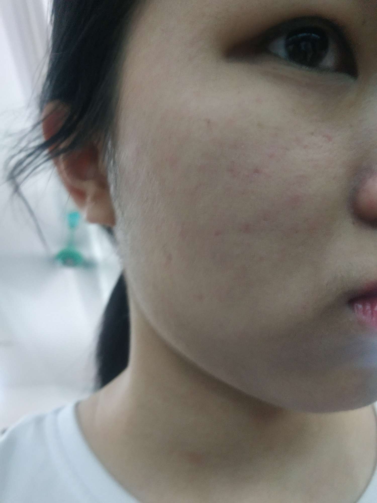 脸上的红点点是激素痘-系统性红斑狼疮患者互助回答