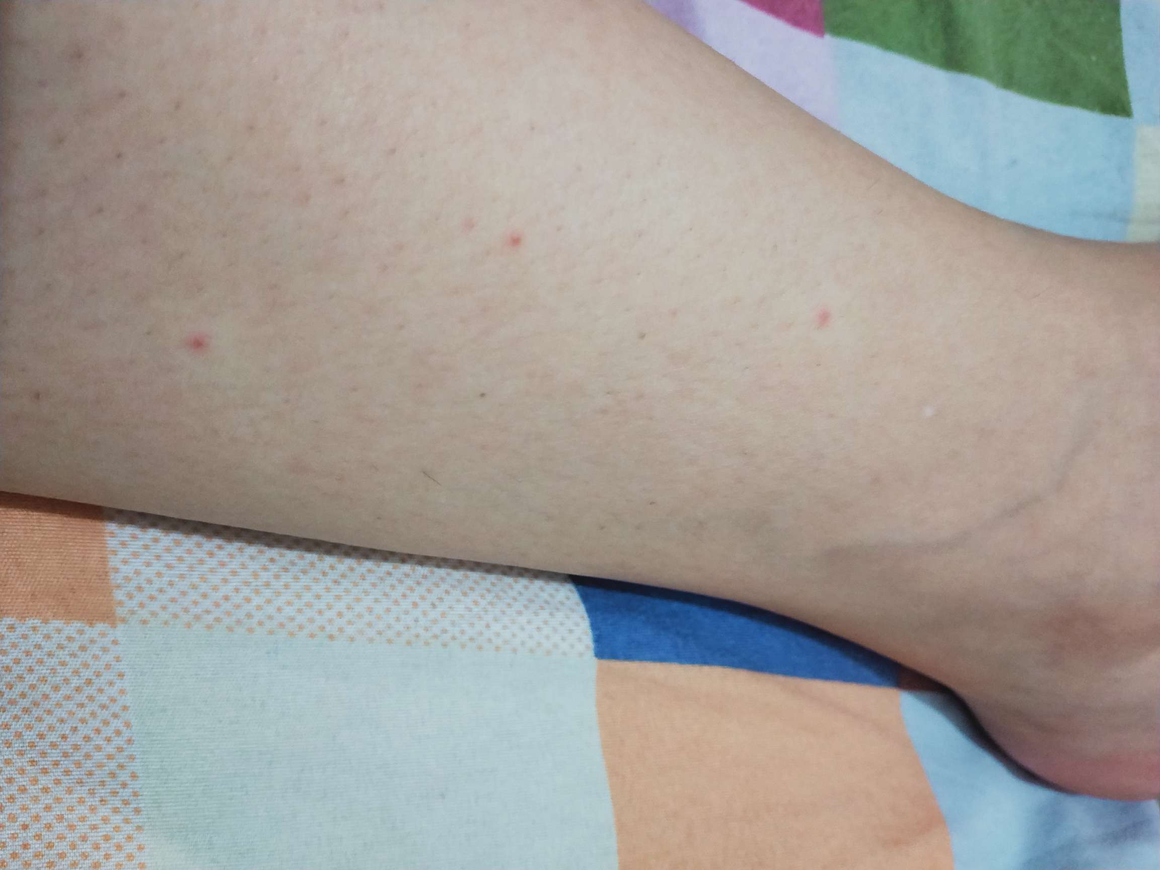 早晚上班晒到了腿,起-系统性红斑狼疮患者互助回答