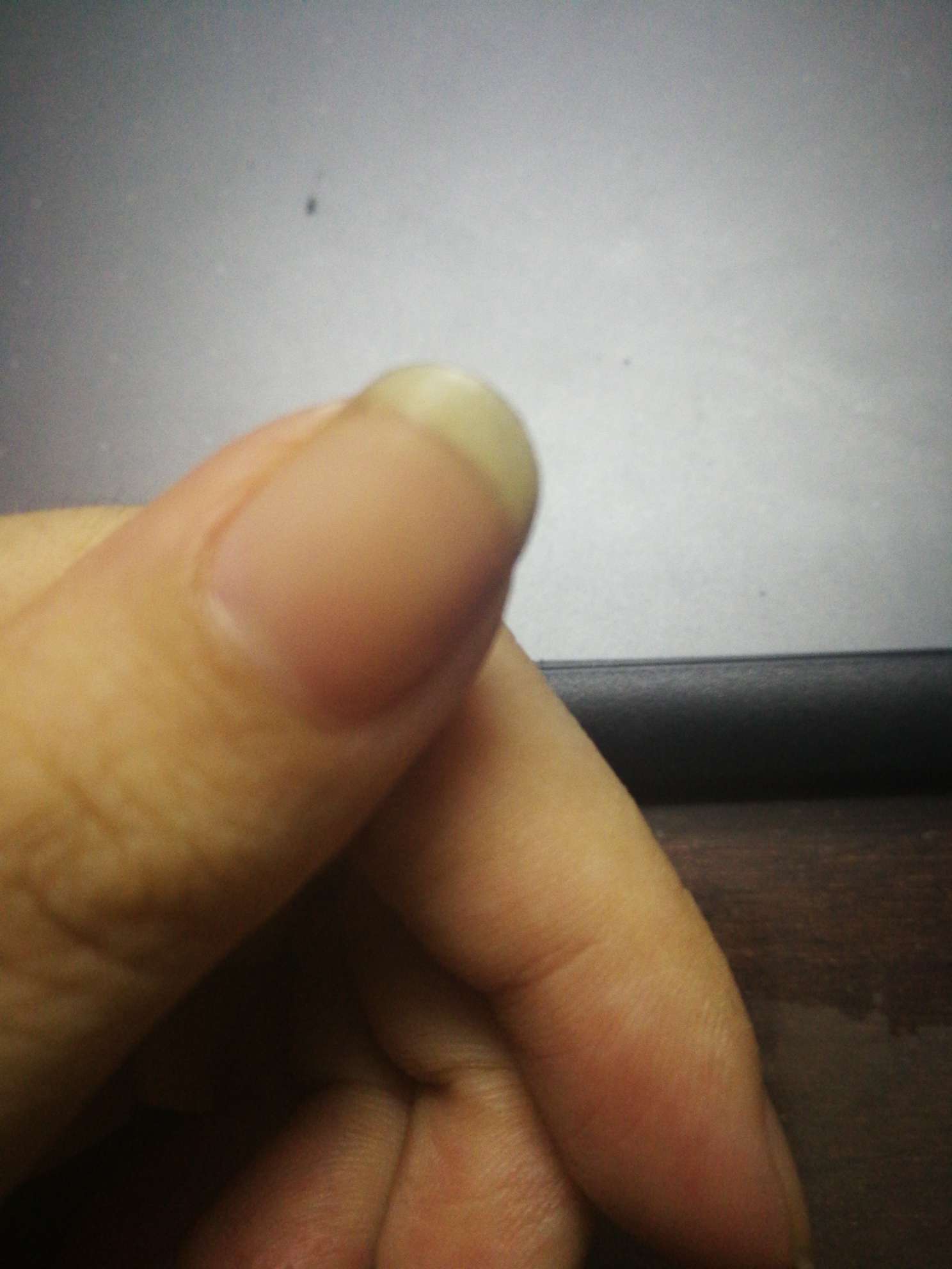 指甲发黄怎么办,以前看互助知道好像是真菌感染了,那要涂什么吗,黄黄