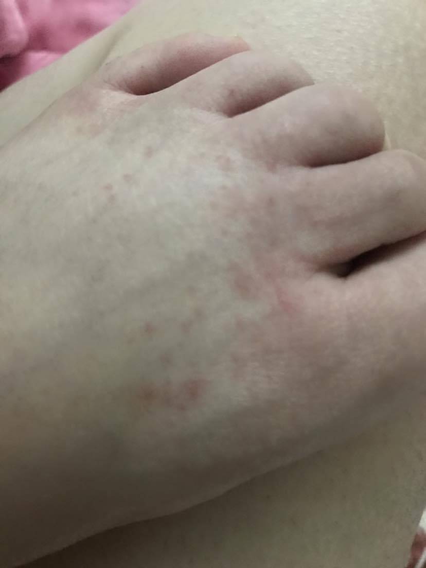 这是什么-系统性红斑狼疮康复圈-觅健