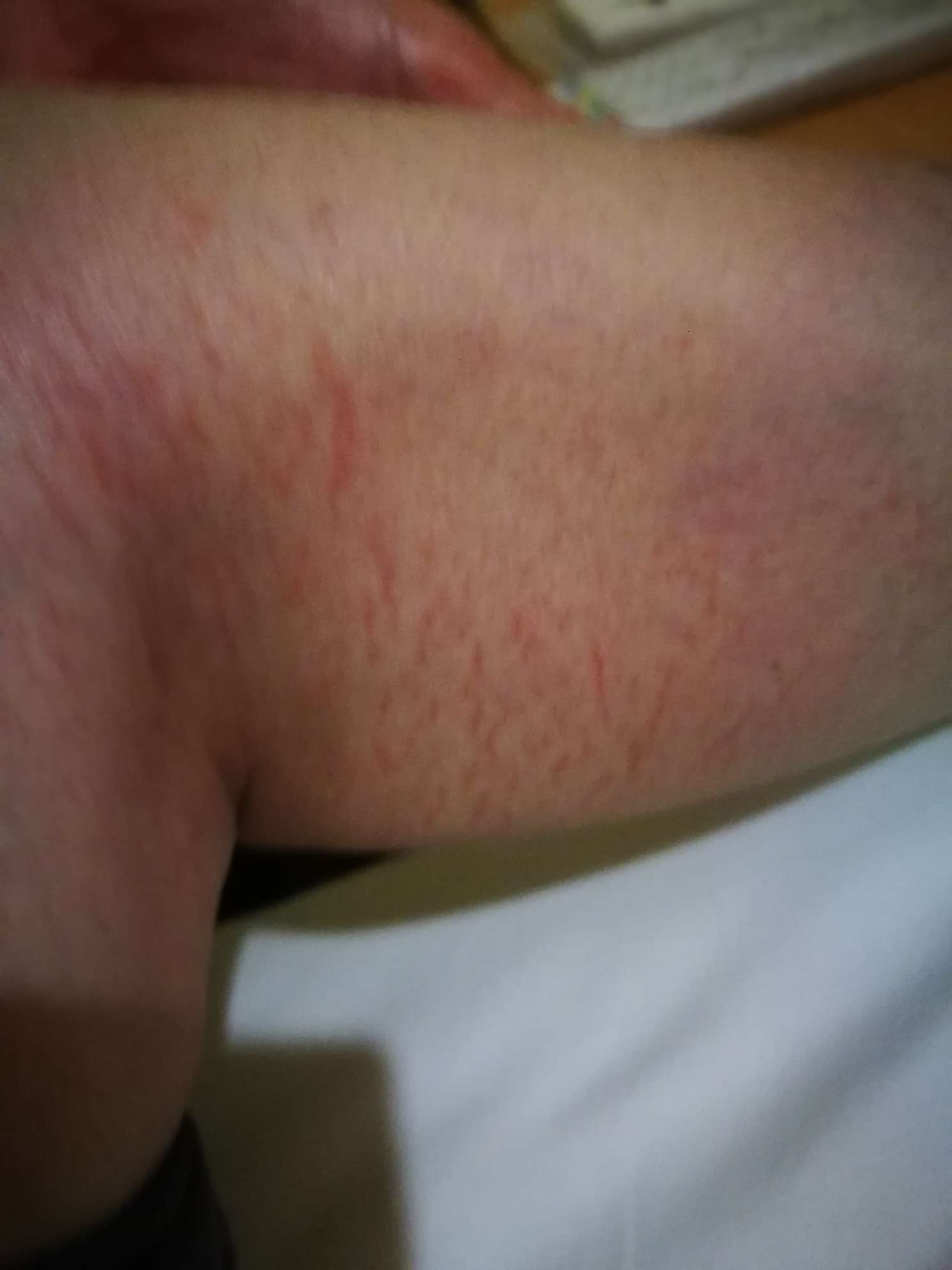 腿上突然皮肤痛,一看长了一条一条的红,好像划伤,有相同的伙伴吗?