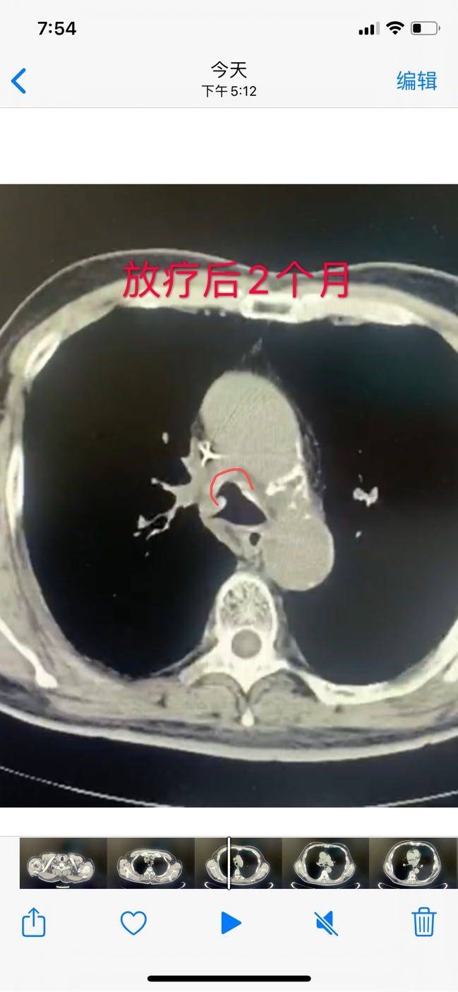 25*o放疗序贯5*k持续缓解