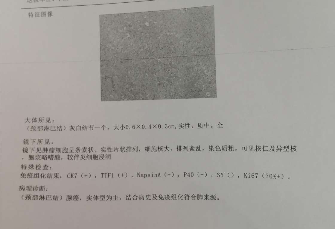 因为我们的主治医生让我们在做颈部淋巴活检时,尽量将肿大淋巴结全切