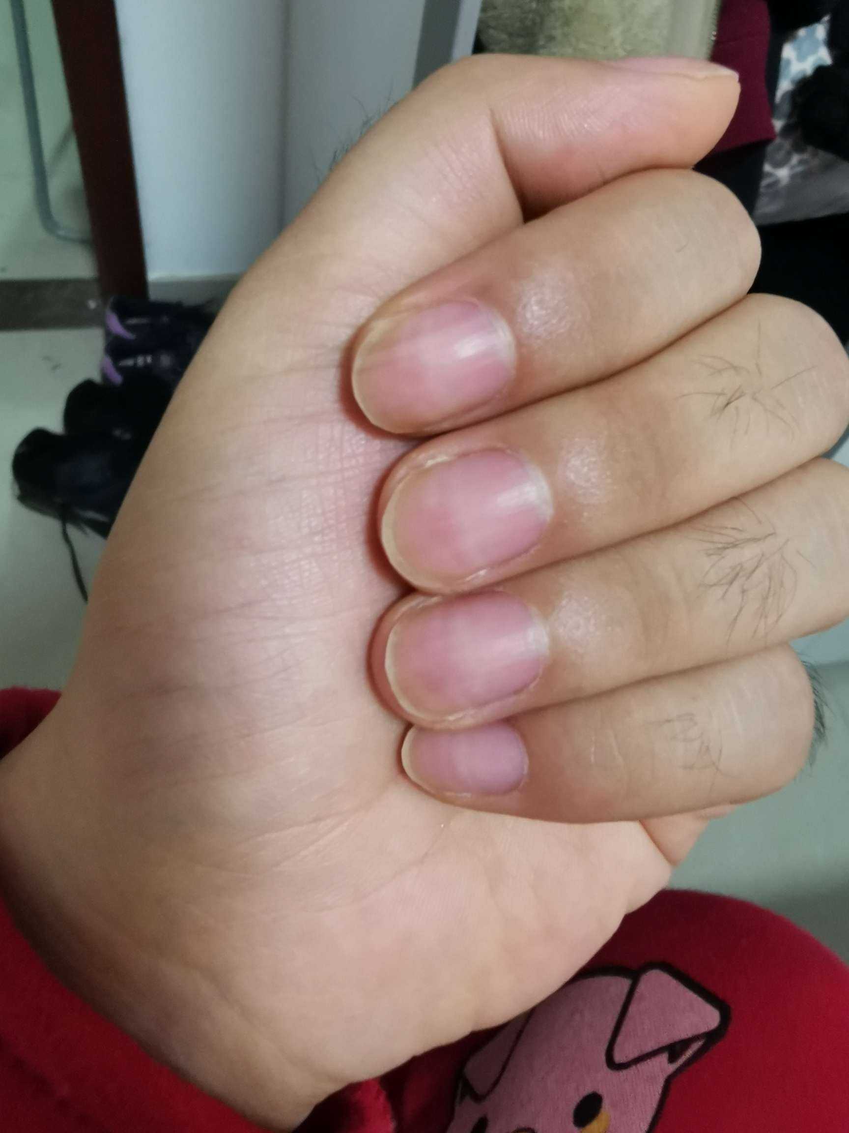化疗结束快三个月,今天发现新长出的指甲颜色比之前的