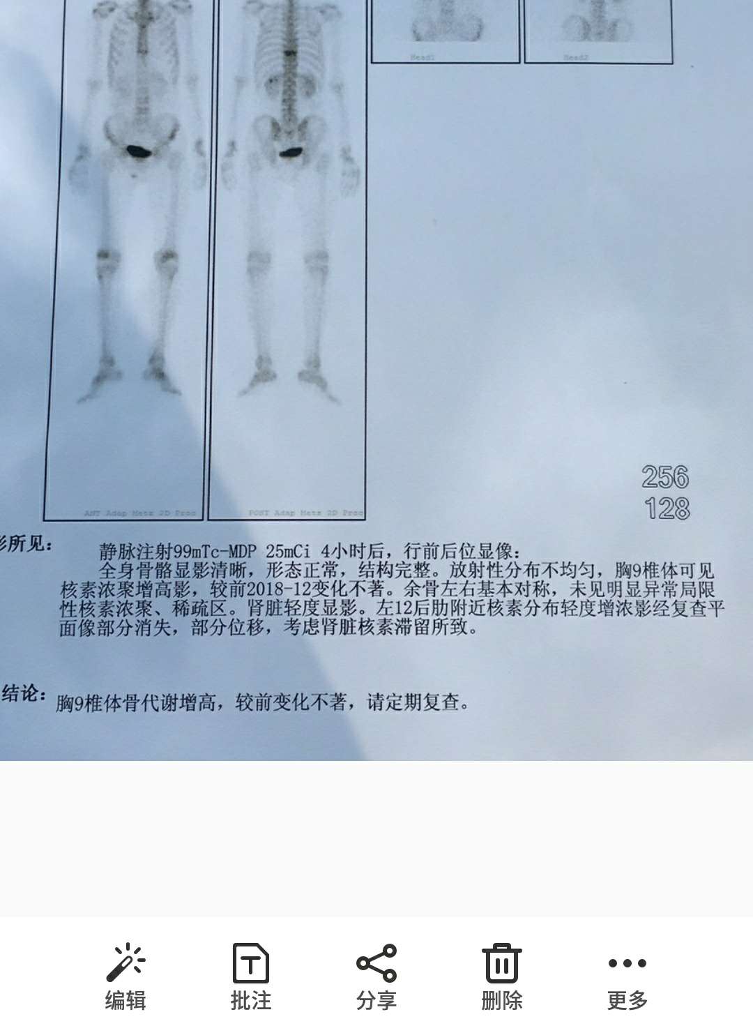 ct有变化了,盆腔积液这个严重不?