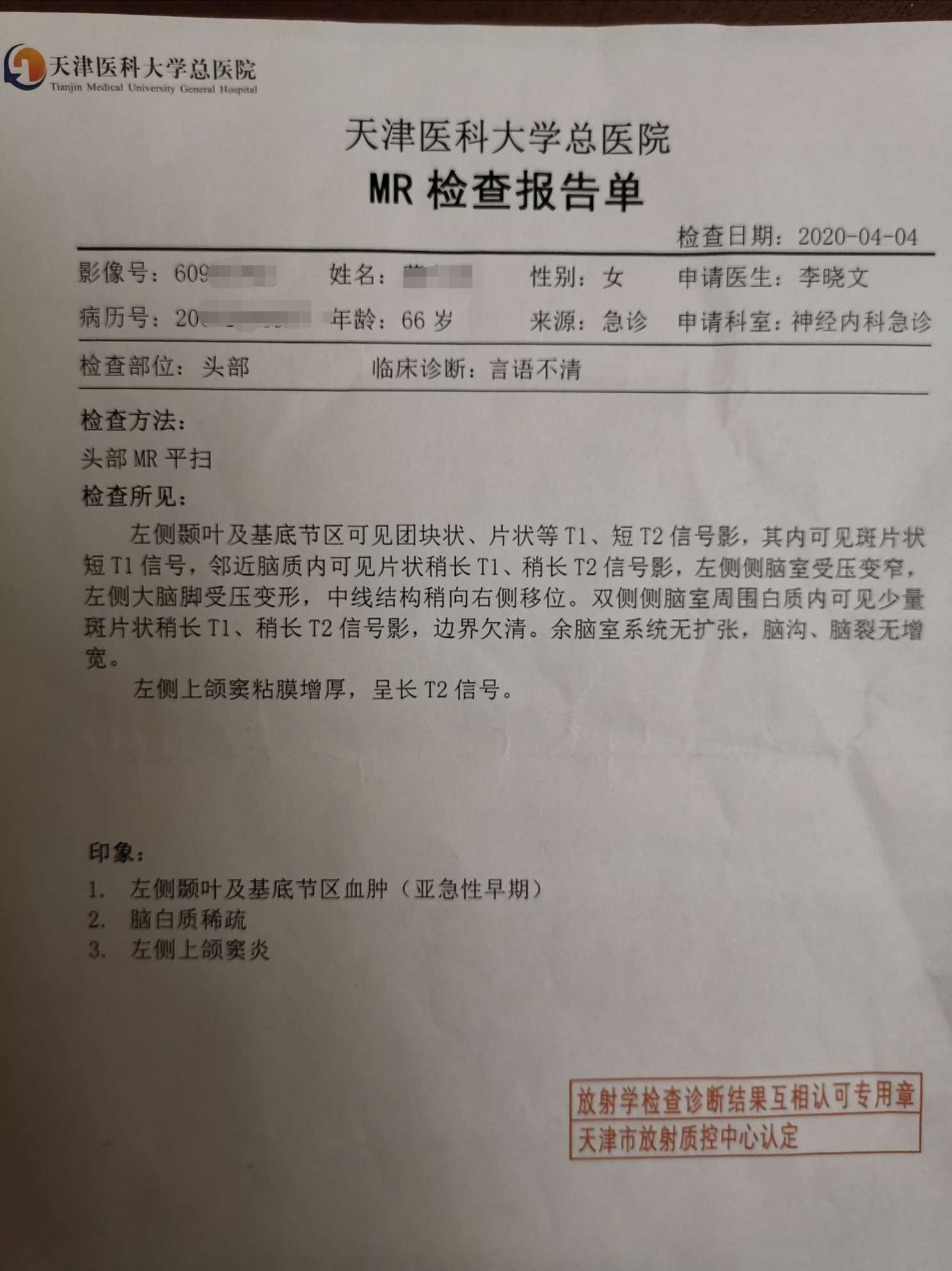 病人肺腺癌4期多发骨转移最近出现言语不清ct和核磁发现头部