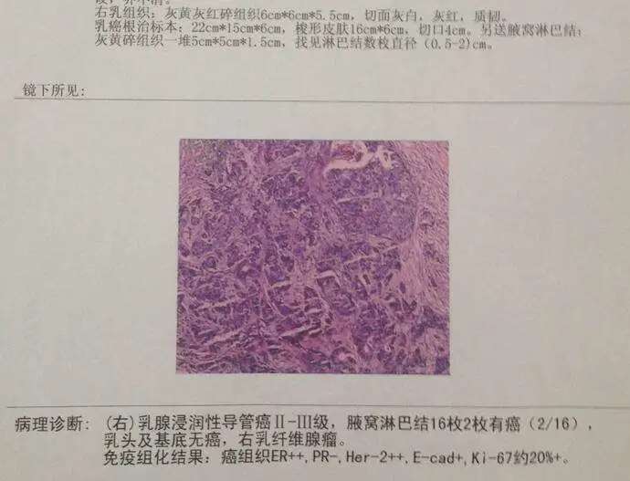 下面是一张很常见的乳腺癌病理报告单,我们就以它为例来进行讲解.