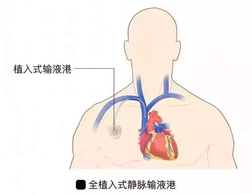 piccampport一根通往心脏的管子