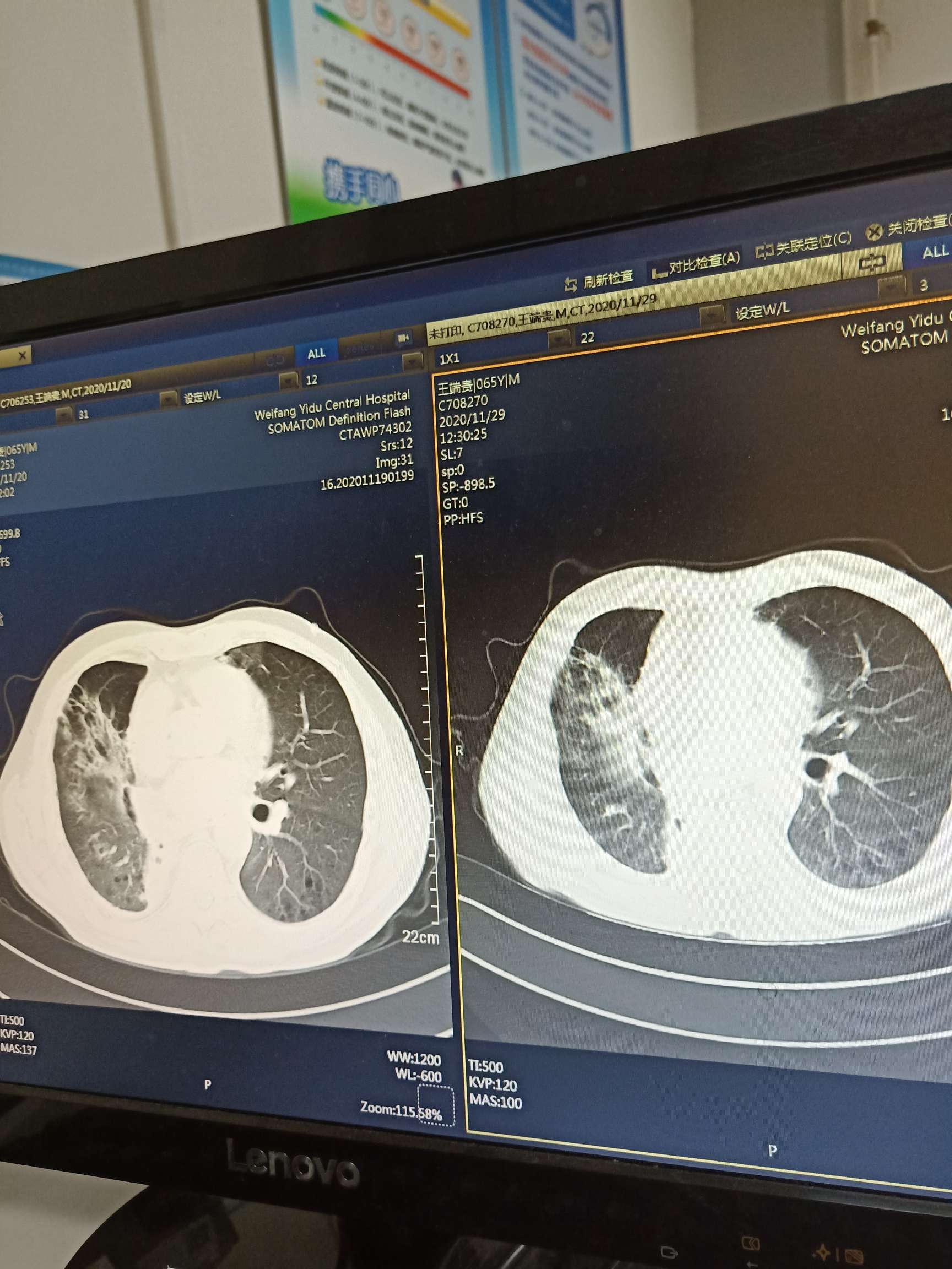 肺纤维化以后还能好转吗?还能免疫治疗吗?以下图片是这十天ct对比.