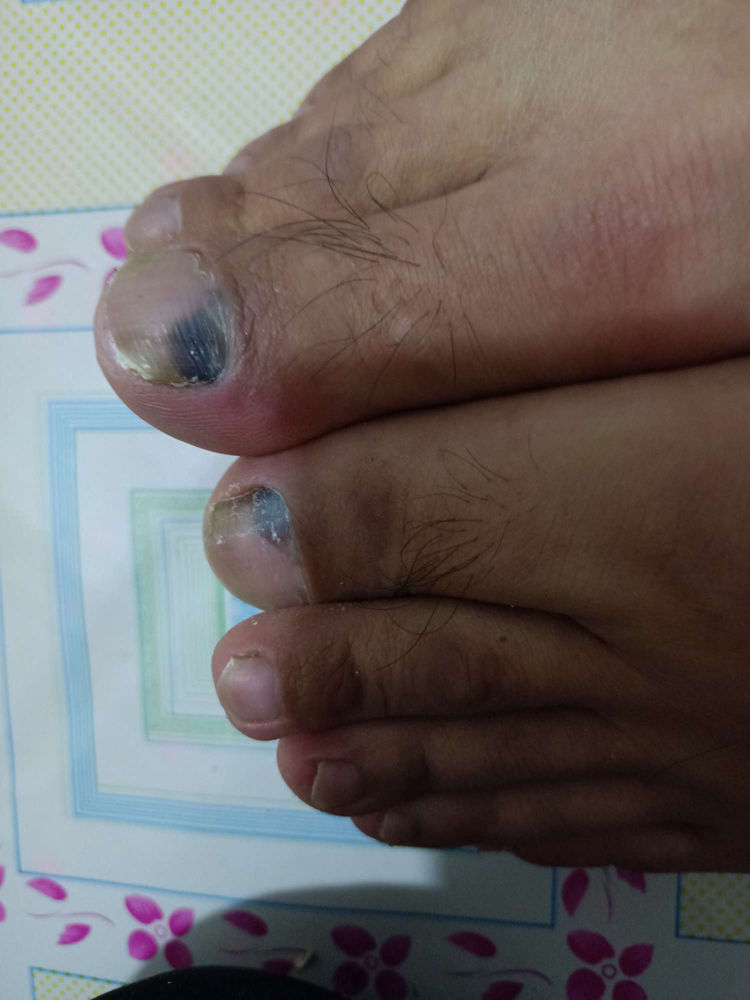 大母脚指甲有一块发黑是灰指甲吗?急急急-系统性红斑