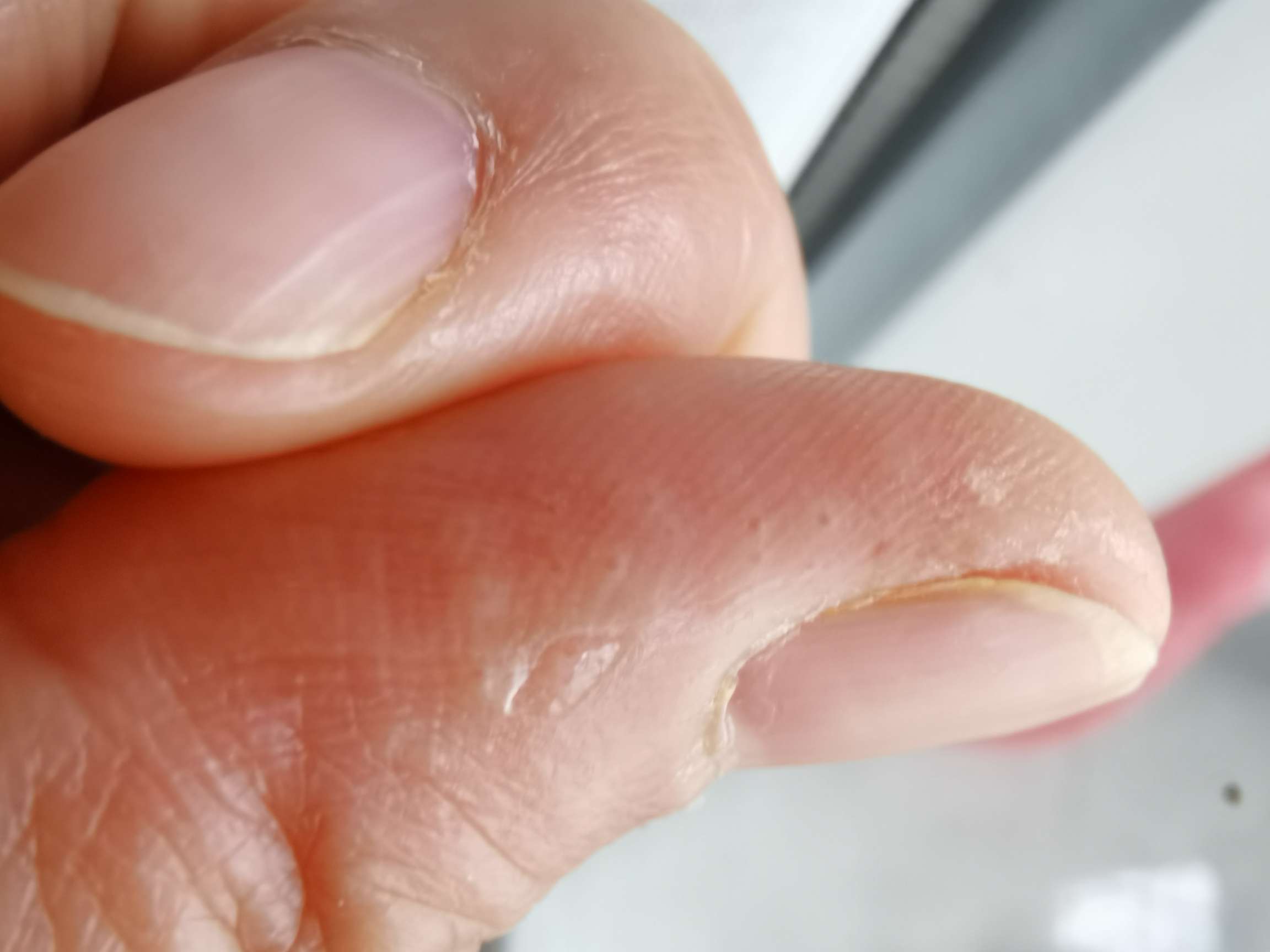 用cdk46也就是爱博新77氟维司群手指上长密密麻麻的小水泡