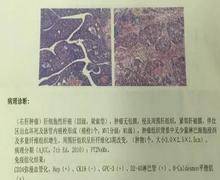 看懂肝癌的「身份证」:病理报告中哪些指标影响肝癌患者预后?
