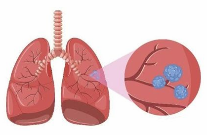 如何判断肺结节的良恶性，查出肺结节都需要“一刀切”？