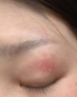   眼皮上有红块 有时候痒 有时候疼 掉皮 快个把月了 疫情原因