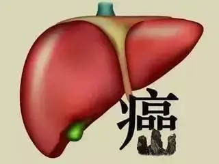 卡瑞利珠单抗二线治疗肝癌效果情况,用卡瑞利珠真实感受!