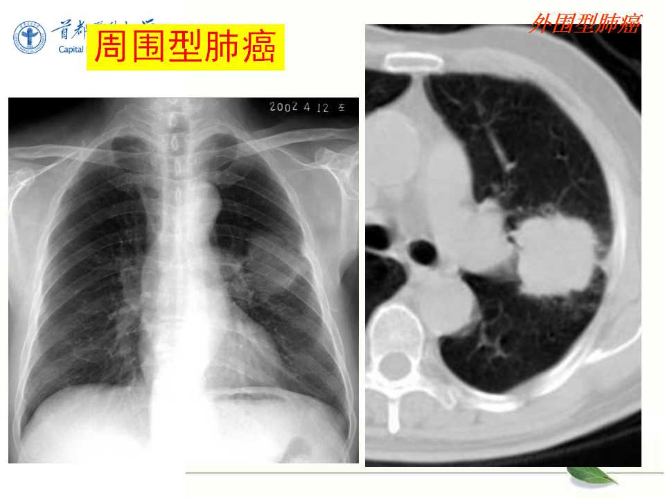 肺癌的影像学检查