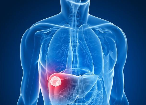 肝囊肿的出现多与3个因素有关可惜很多人不清楚