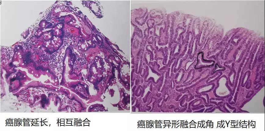 胃癌病理基础知识大盘点