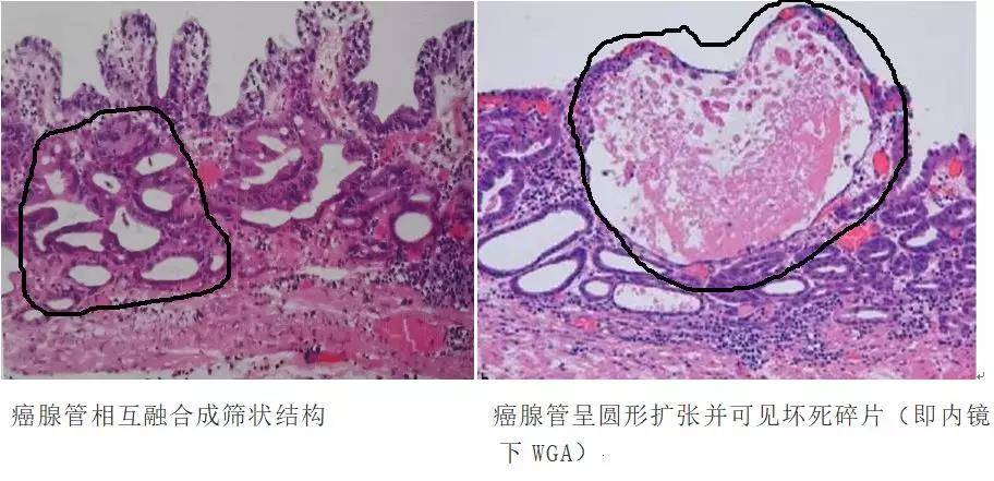 胃癌病理基础知识大盘点