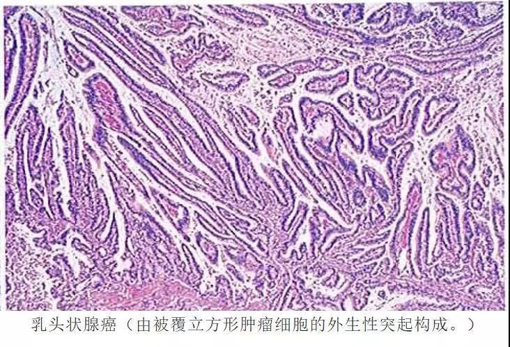 根据分化程度可进一步分为高分化,中分化和低分化管状腺癌