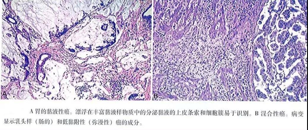 图24 胃黏液腺癌,混合型癌病理图