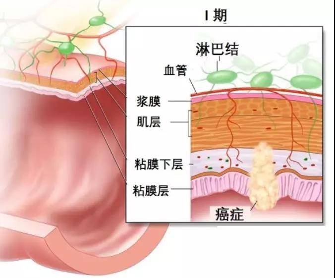 直肠癌切缘不仅包括远近端,还包括环周是否切除干净.