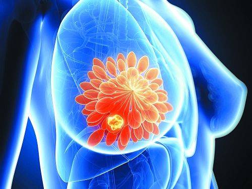 晚期乳腺癌