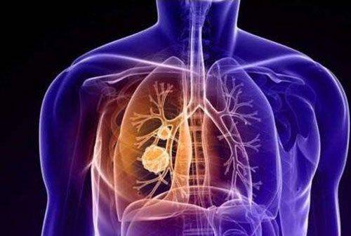 晚期肺癌