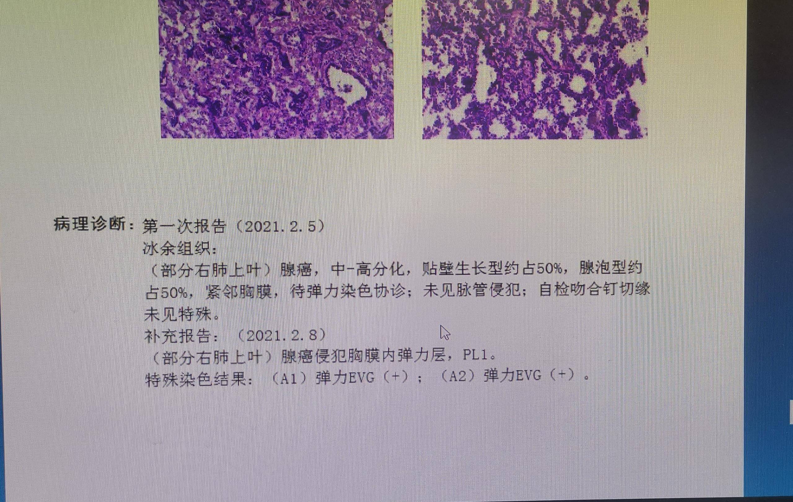腺癌侵犯胸膜弹力层该怎么治疗-肺癌康复圈-觅健