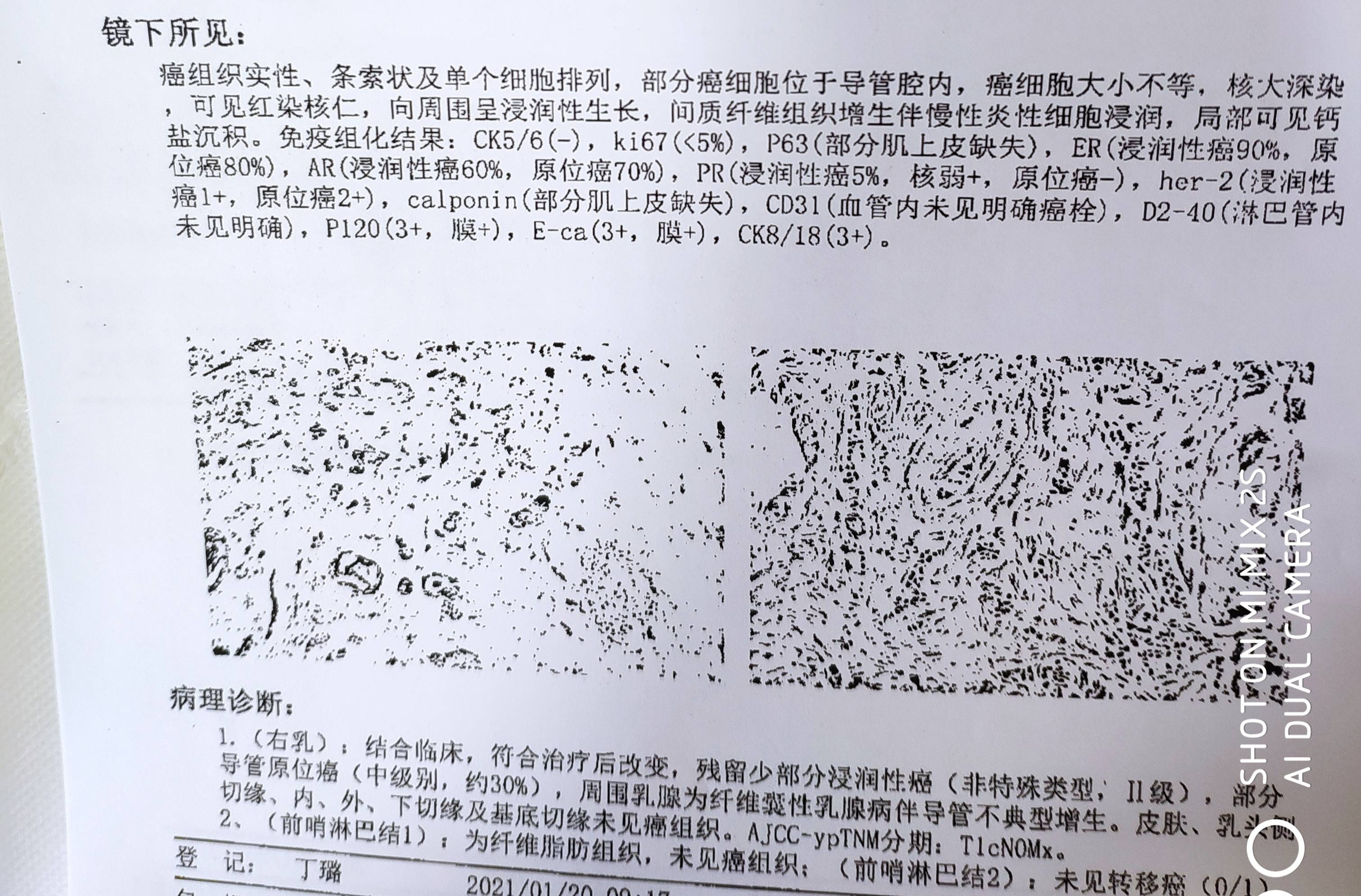 浸润性导管癌ia期腔面b型