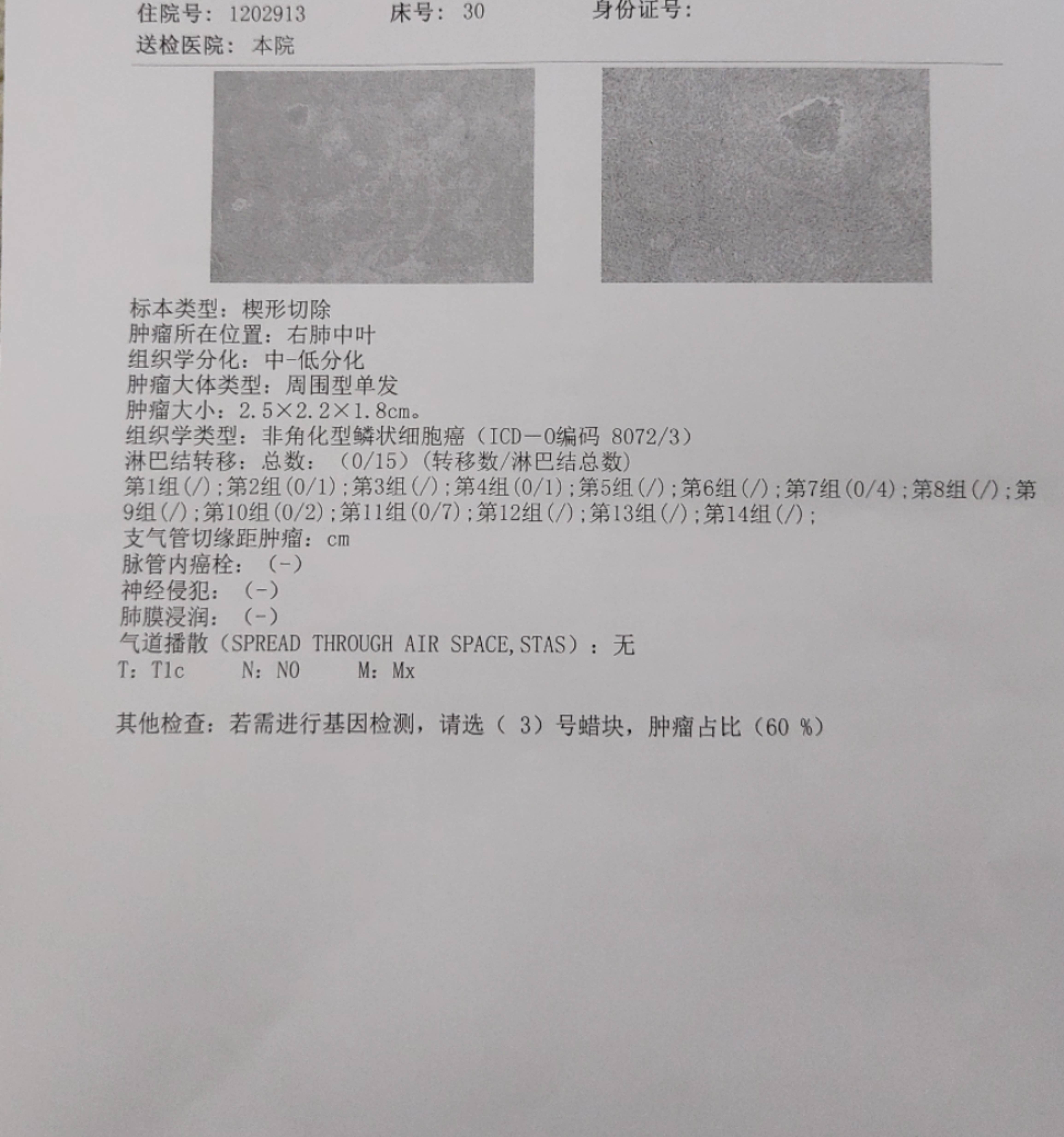 正文 今天去医院拿到了病理报告,对着这个病理报告,内心毫无波澜,只有