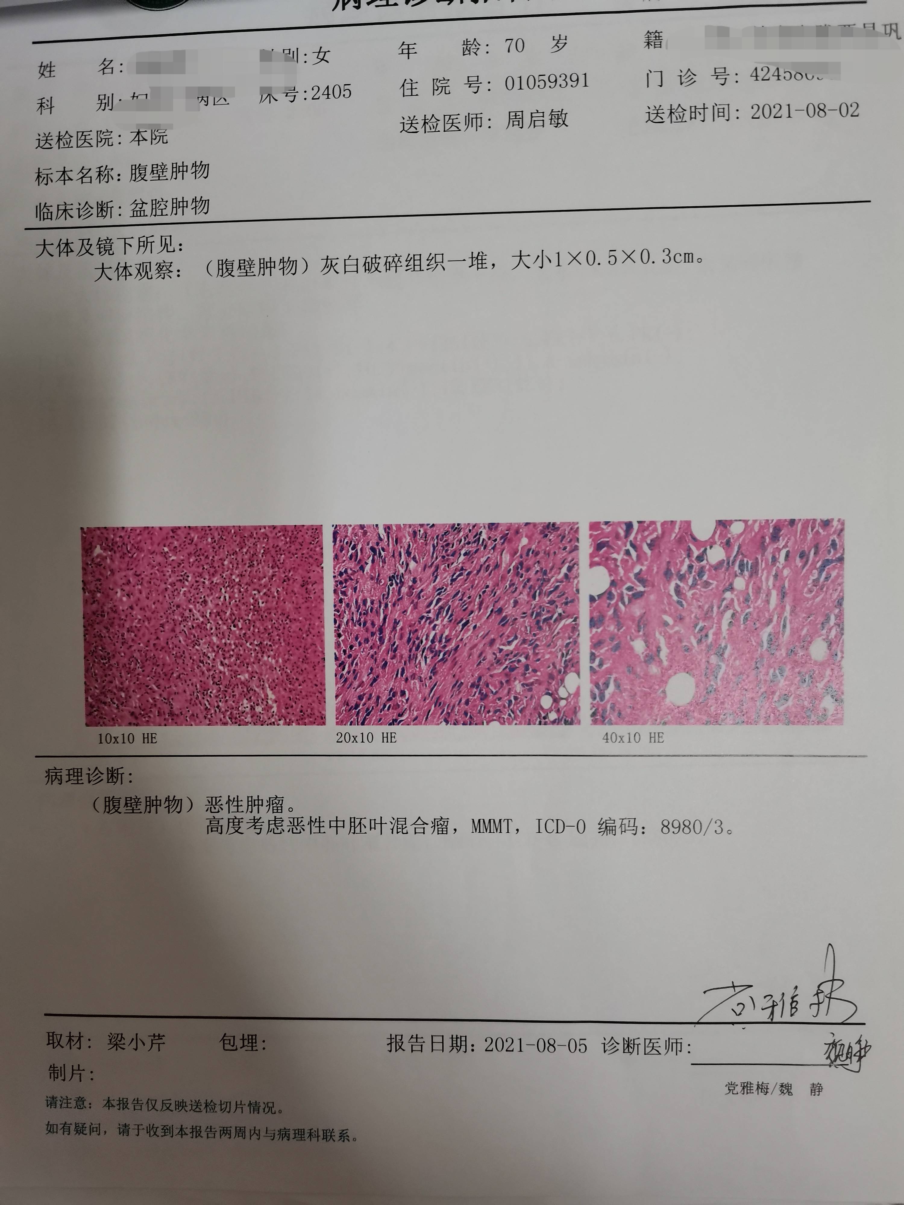 恶性中胚叶混合瘤